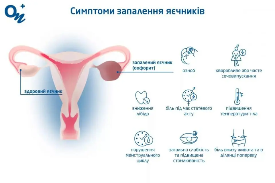 як болить яєчник