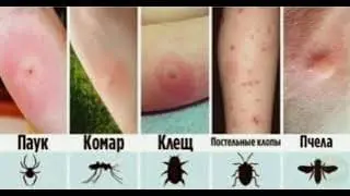 як виглядає укус павука