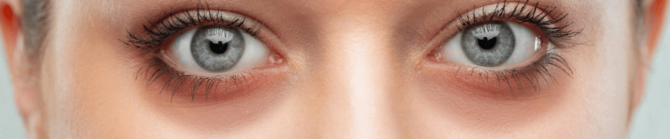 Як прибрати синці під очима в домашніх умовах