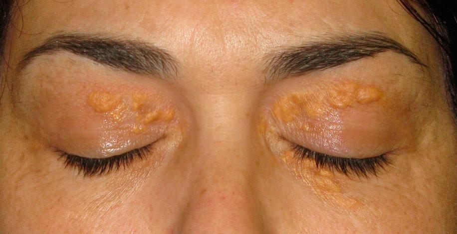Ксантелазма век на фото 